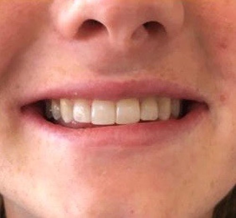 chantelle-6-month-braces-after